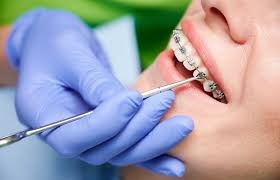 Braces