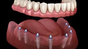 Fixed Dentures