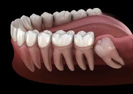 Impaction Service