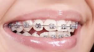 Advanced Orthodontic Treatment