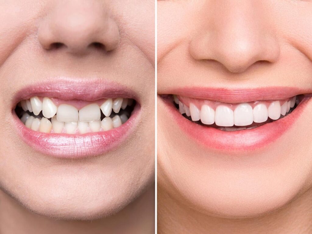 Smile Designing