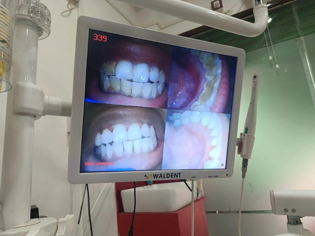 Intraoral camera full mouth scan
