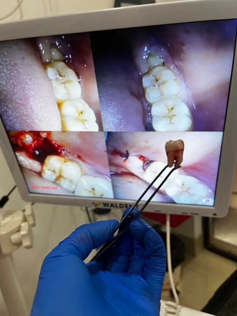 Tooth extraction procedure