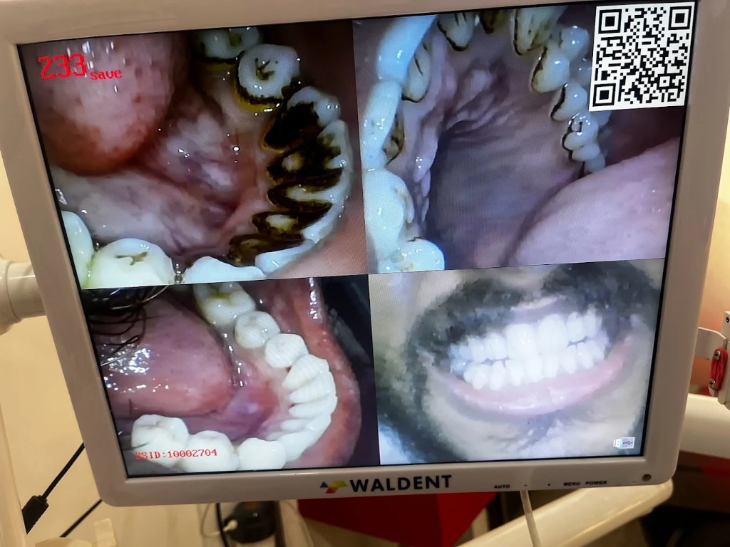 Intraoral camera diagnosis