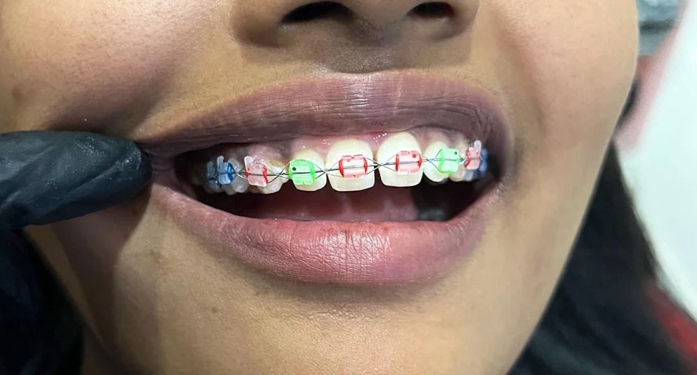 Braces orthodontic treatment