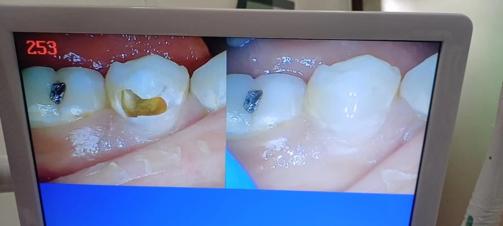 Dental crown restoration